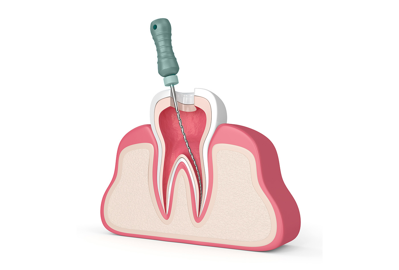 Traitement de canal » Mon Dentiste Boisbriand